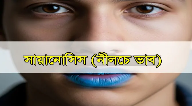 সায়ানোসিস (নীলচে ভাব): একটি গুরুতর লক্ষণ